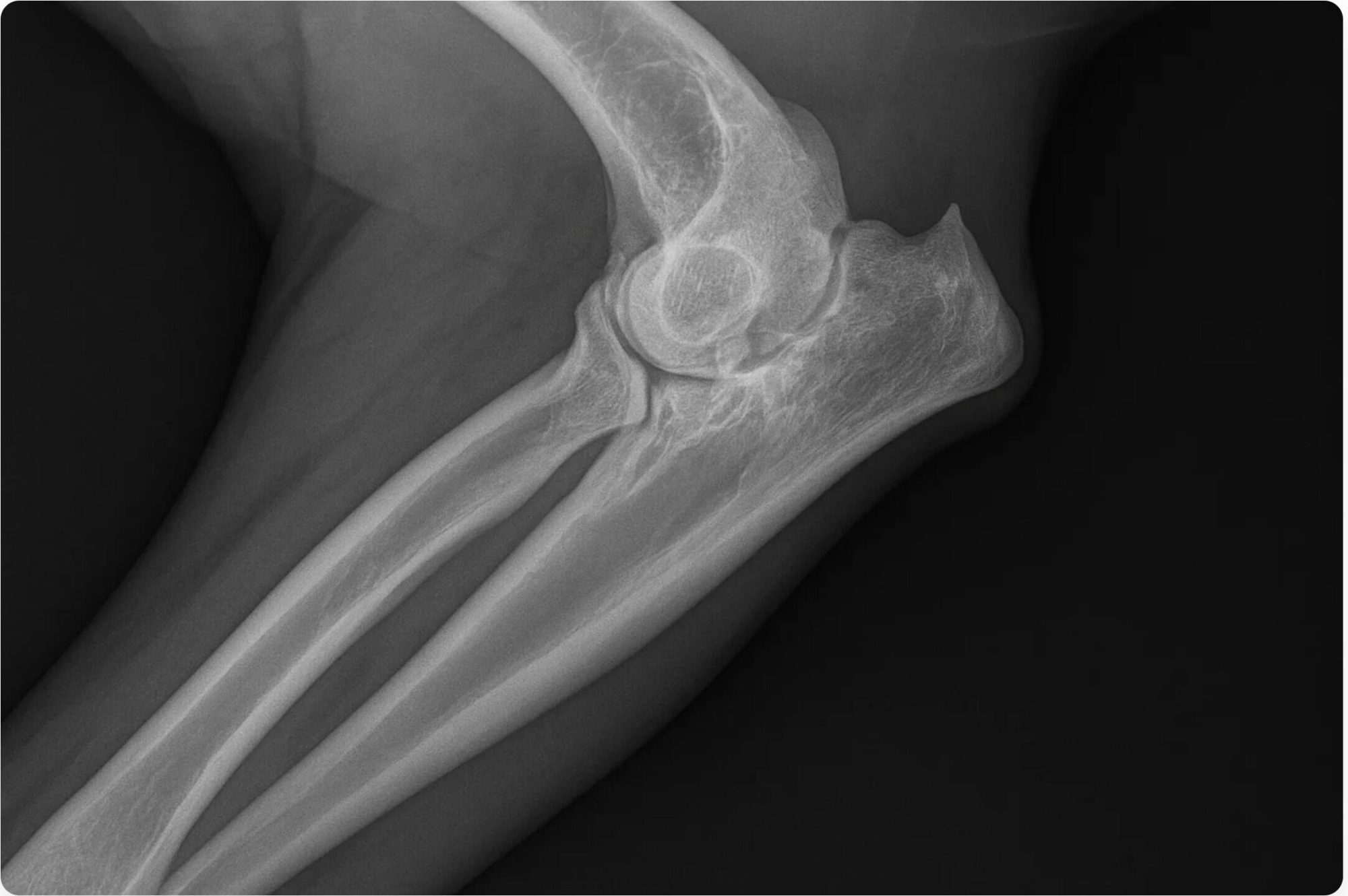 Radiograph of a dysplastic elbow
